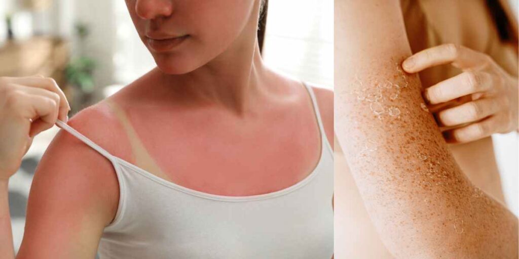 Mitigating Sunburn and Promoting Even Skin Tone