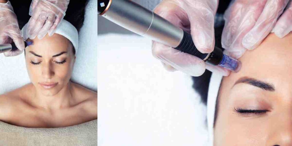 Microneedling